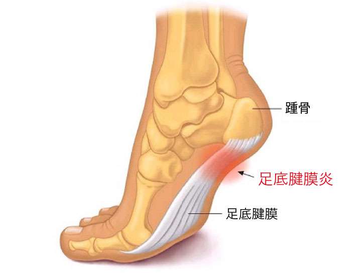 足底腱膜炎について