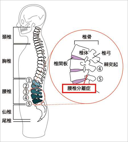 腰椎分離症について　神戸の整形外科　おかだ整形外科