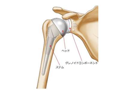 人工肩関節置換術について