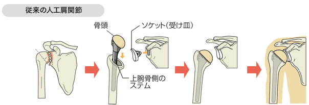 Test（人工肩関節置換術について） | 神戸にある整形外科医院・おかだ 